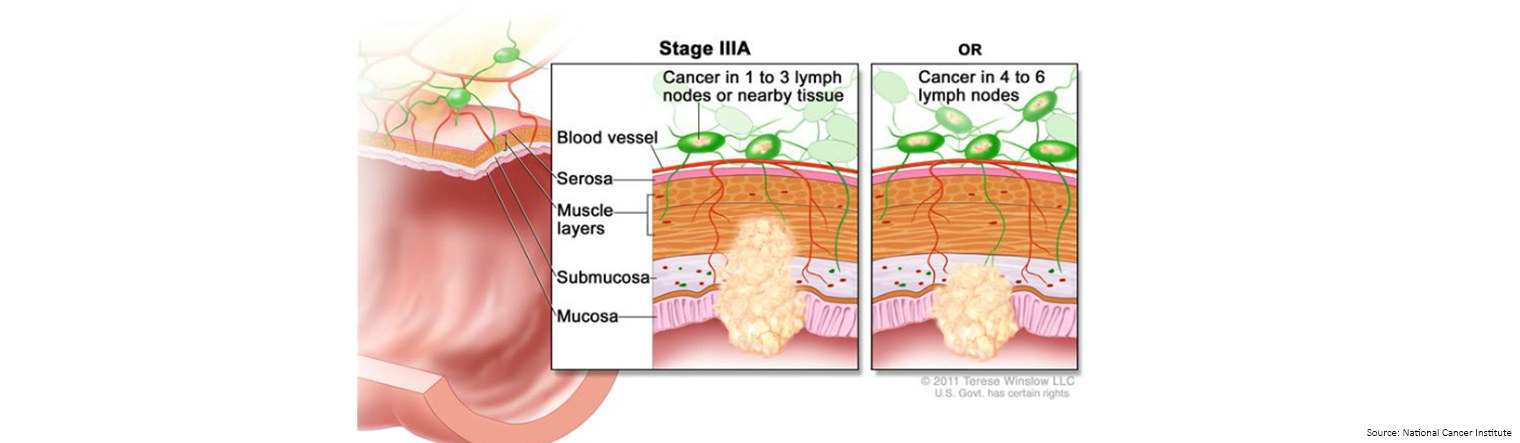Bowel Cancer Staging Stage 3a