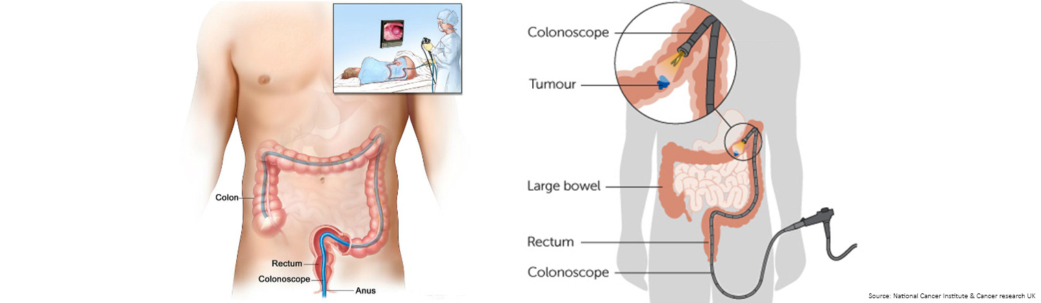 How is a colonoscopy performed